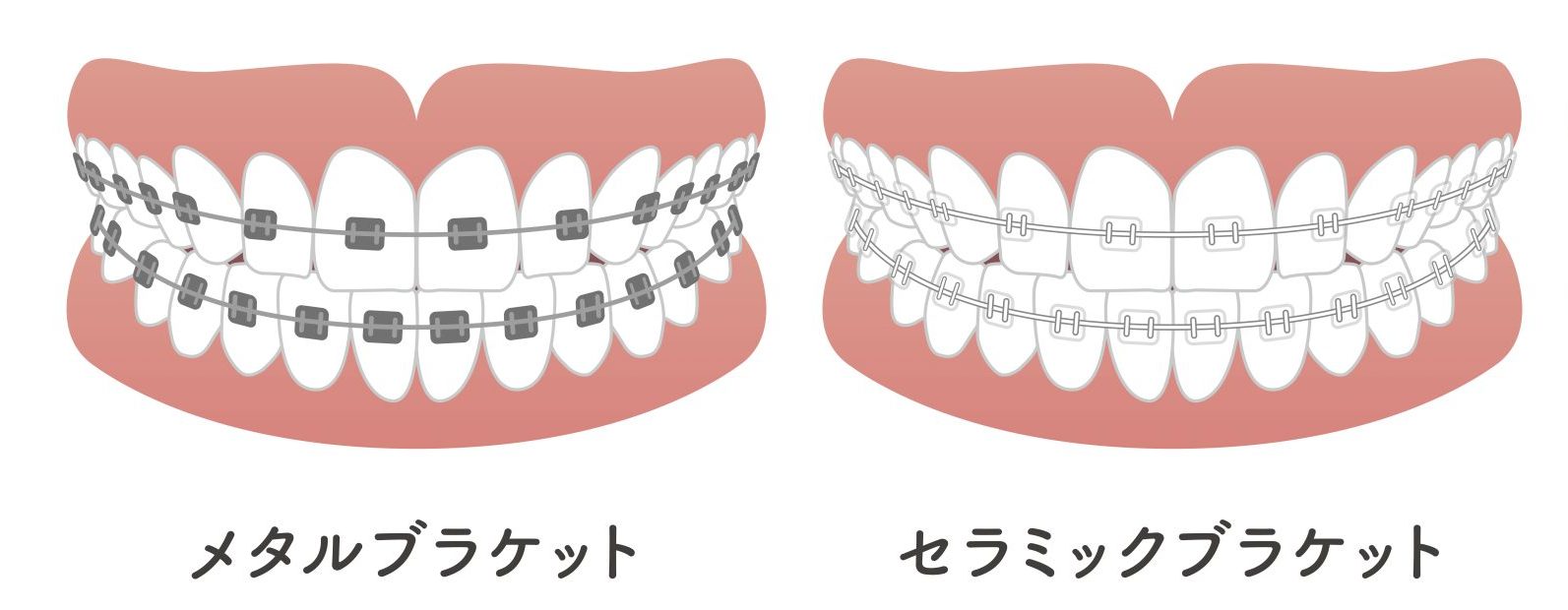 目立たないワイヤー矯正が可能です…！