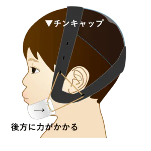 チンキャップ