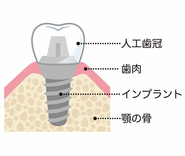 インプラントとは