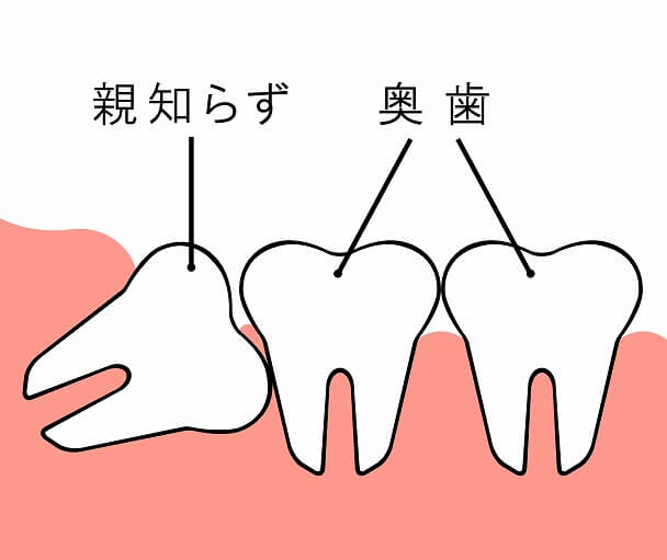 親知らずの抜歯